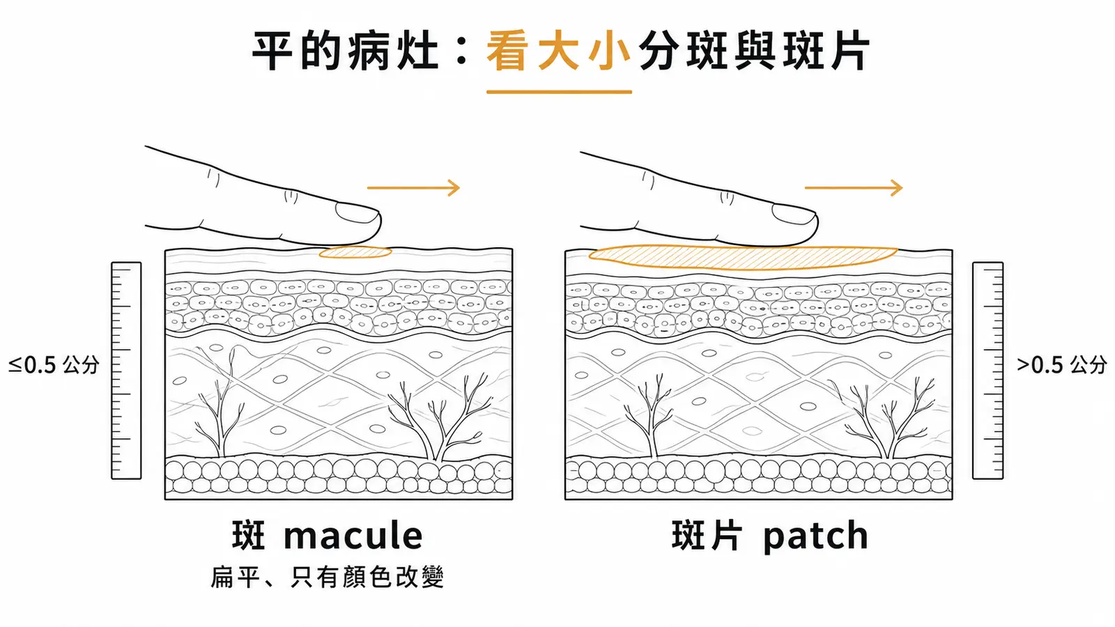 扁平病灶斑與斑片對照:都是摸不出高低、只有顏色改變的病灶,斑(macule)直徑 ≤0.5 公分、斑片(patch)>0.5 公分