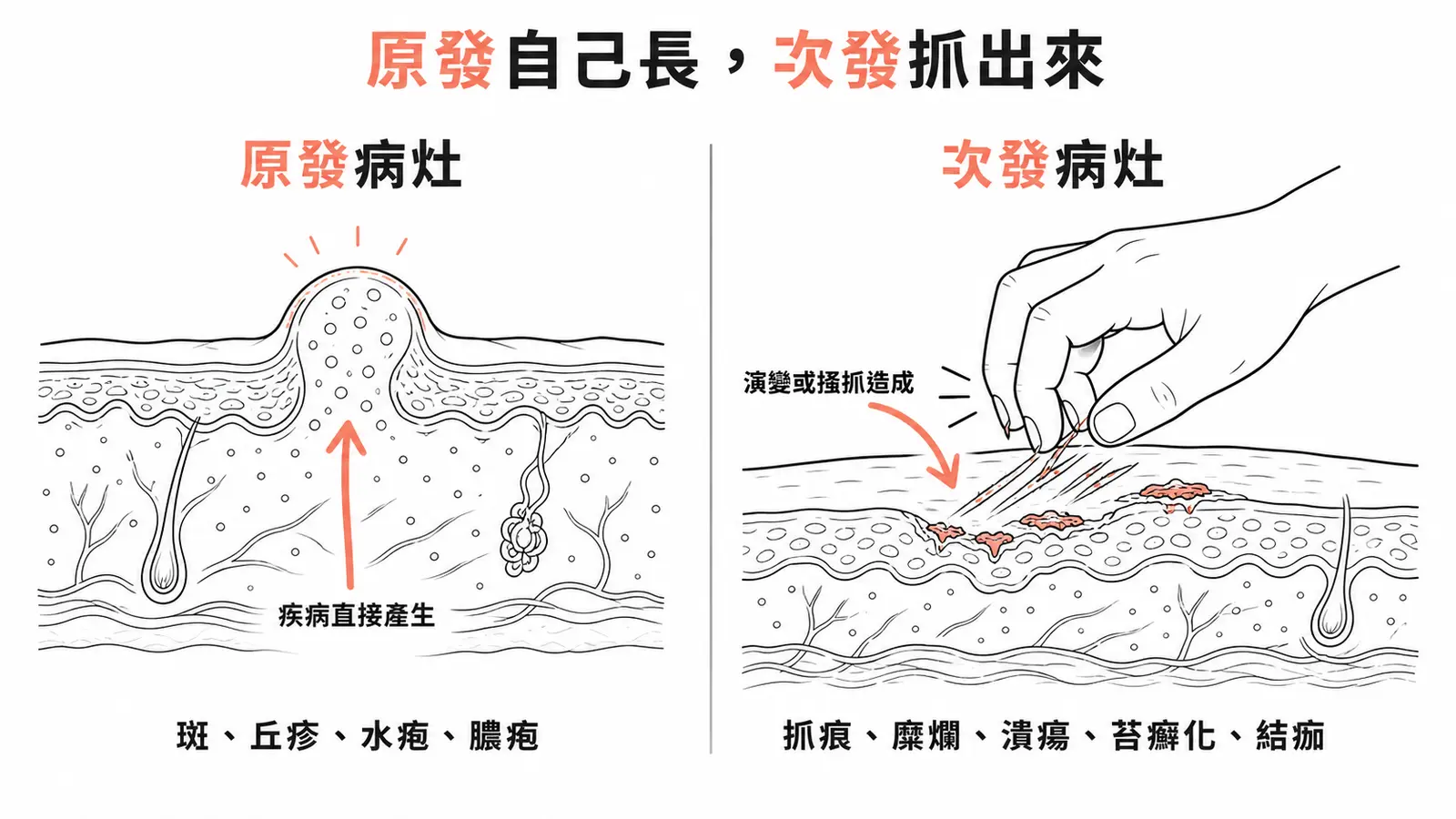 原發與次發病灶對照:原發病灶是疾病直接產生(斑、丘疹、水疱等),次發病灶是演變或搔抓造成(抓痕、糜爛、潰瘍、苔癬化、結痂)