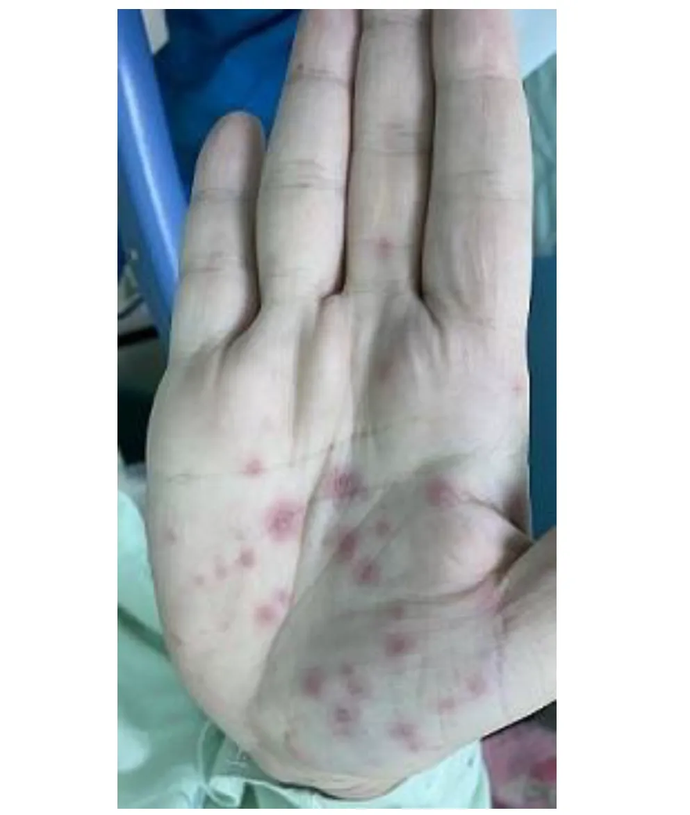 多形性紅斑:手部的靶心狀病灶