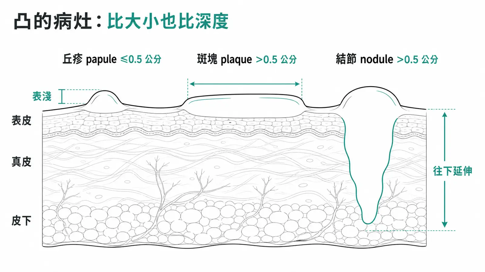 隆起實心病灶剖面對照:丘疹(papule)≤0.5 公分的淺層小隆起、斑塊(plaque)>0.5 公分的平頂寬廣隆起、結節(nodule)深入真皮或皮下的深部隆起