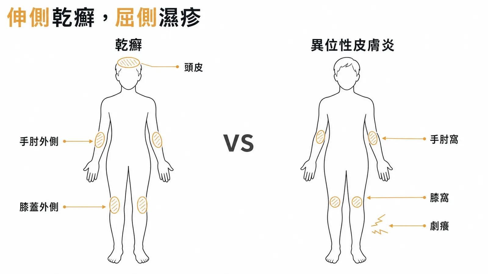 乾癬伸側 vs 異位性皮膚炎屈側:分布位置一刀切