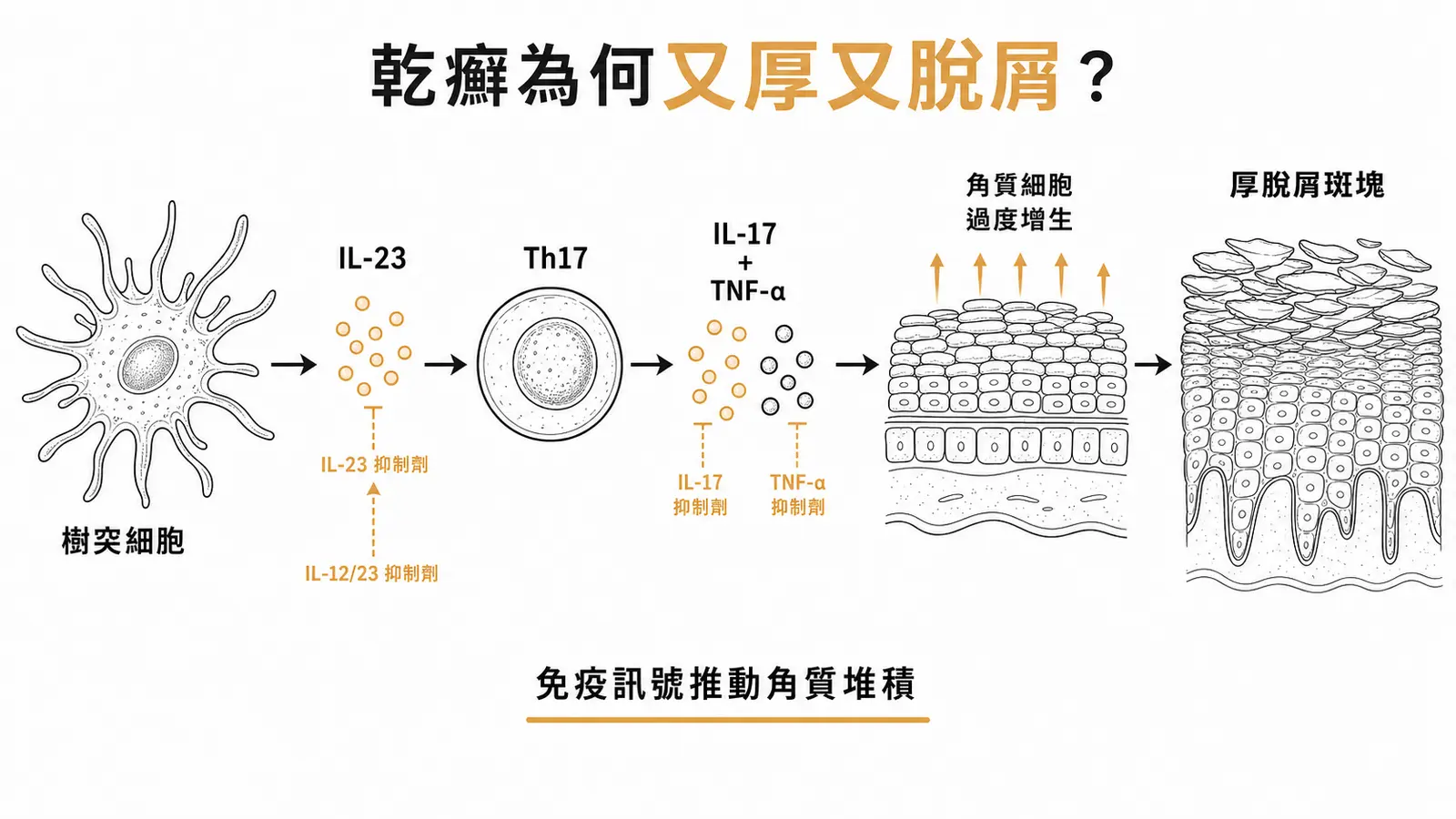 乾癬發炎軸：樹突細胞放 IL-23 推動 Th17 分泌 IL-17，加 TNF-α 逼角質細胞過度增生
