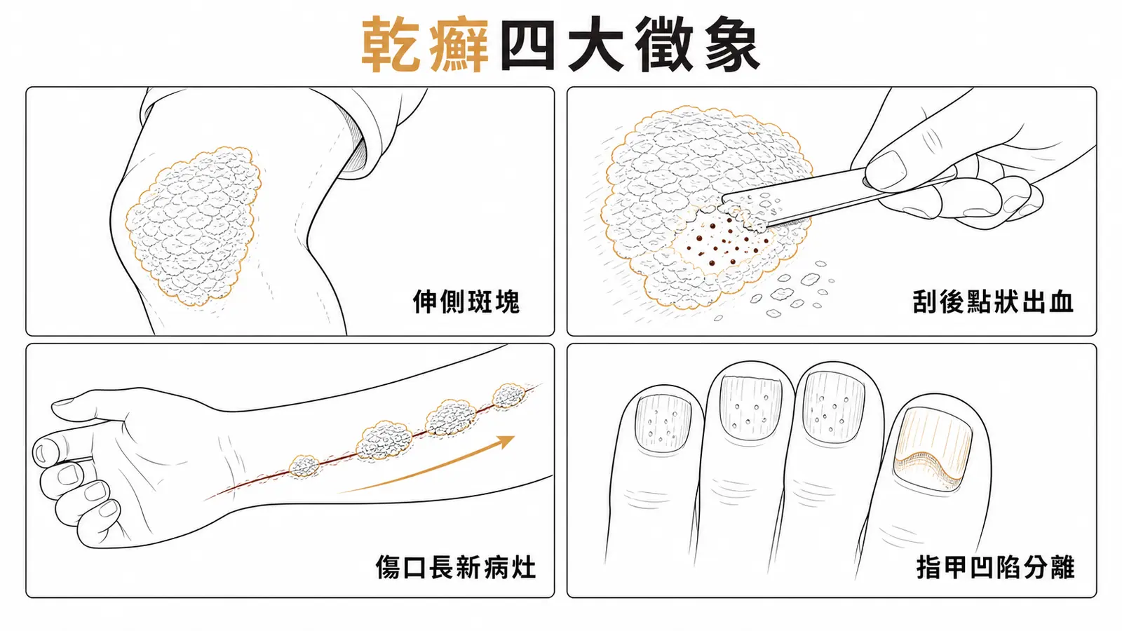 斑塊型乾癬經典徵象:伸側銀白鱗屑斑塊、Auspitz 點狀出血、Koebner、指甲點狀凹陷
