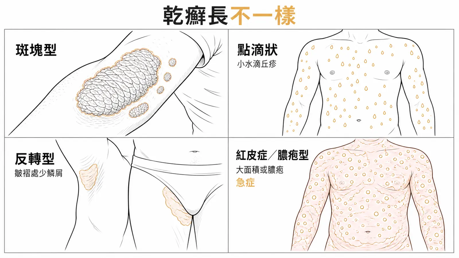 乾癬變異型:斑塊型、點滴狀、反轉型、紅皮症/膿疱型