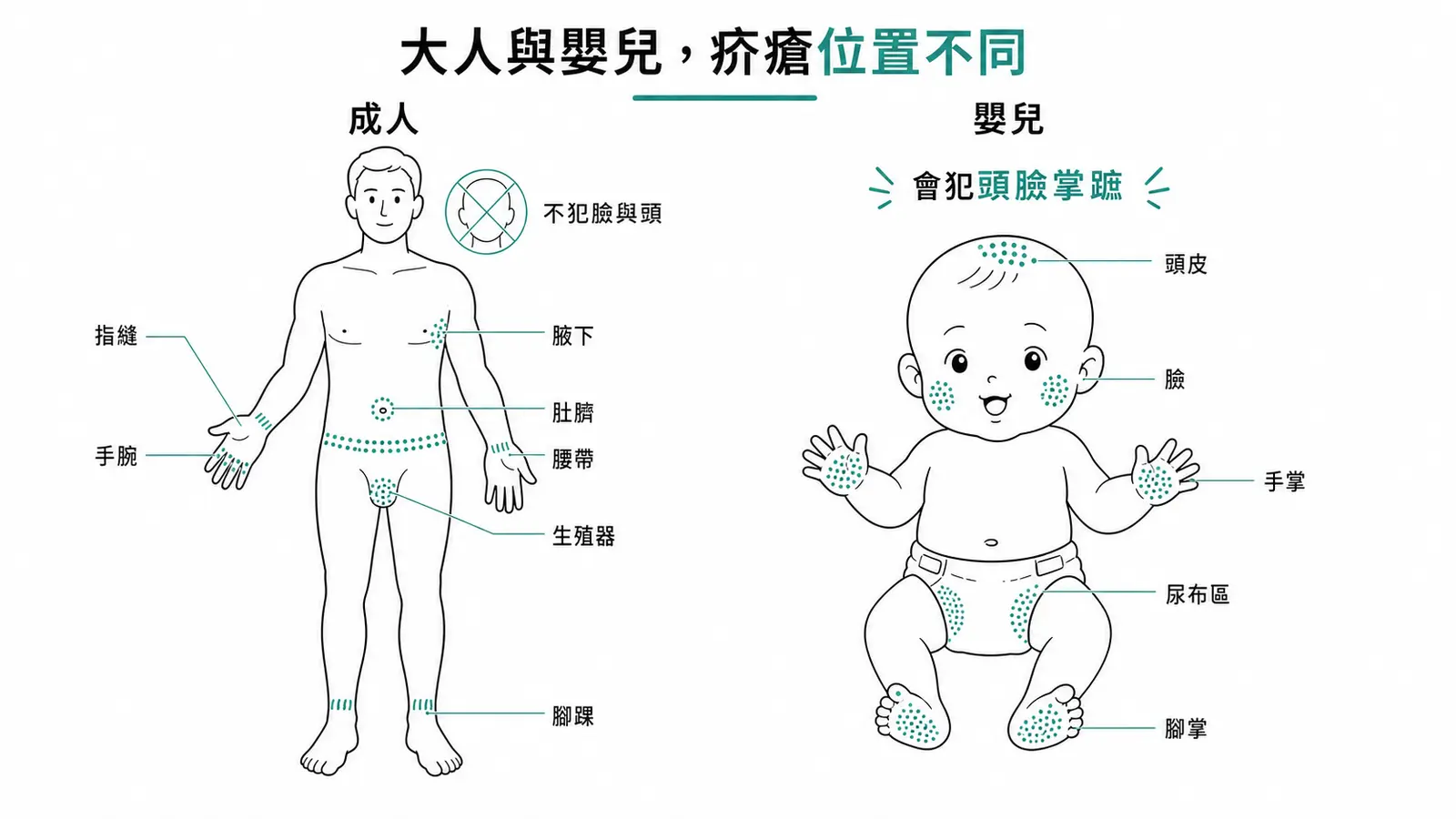 疥瘡好發部位成人與嬰兒對照:成人集中在指縫、腕屈、腋下、臍周、腰帶、生殖器、腳踝且不犯臉頭;嬰兒則會犯頭皮、臉、手掌、腳掌、尿布區