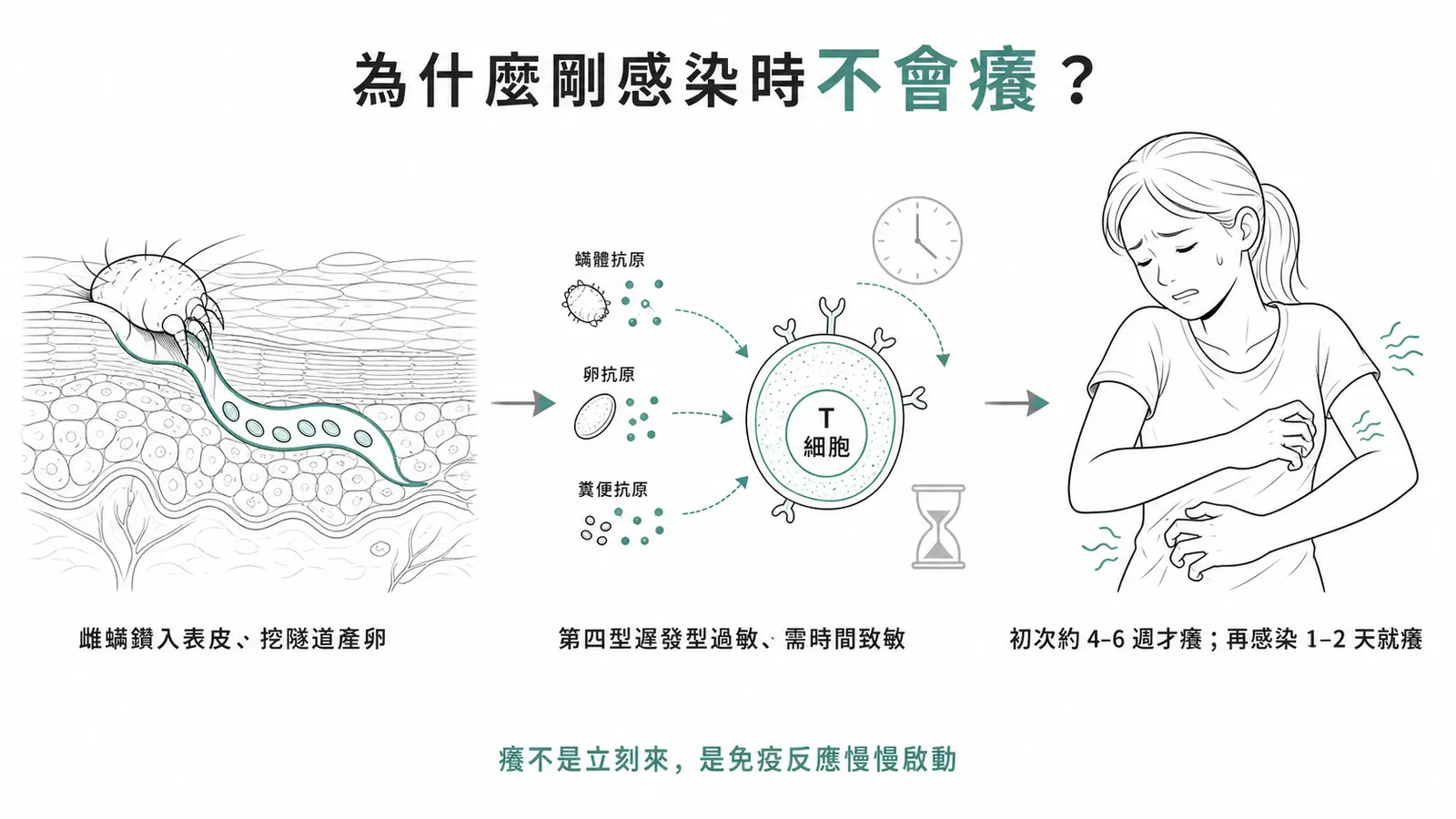 疥瘡致癢機轉流程:雌蟎鑽入表皮挖隧道產卵,經第四型遲發型過敏反應需時間致敏,初次感染約 4–6 週才發癢、再次感染 1–2 天就癢