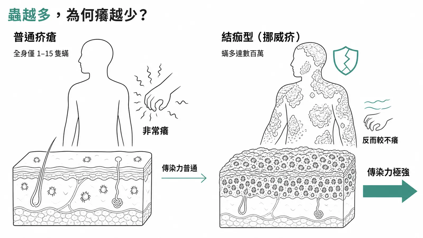 普通疥瘡與結痂型(挪威疥)的反差對照:普通型全身僅 1–15 隻蟎卻非常癢、傳染力普通;結痂型蟎多達數百萬、反而較不癢、傳染力極強
