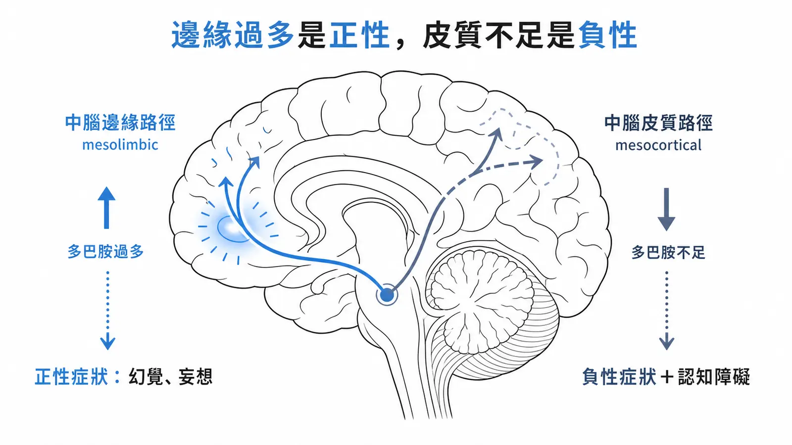 思覺失調症多巴胺兩路徑對照：中腦邊緣路徑過度活化對應正性症狀，中腦皮質路徑功能低下對應負性與認知症狀