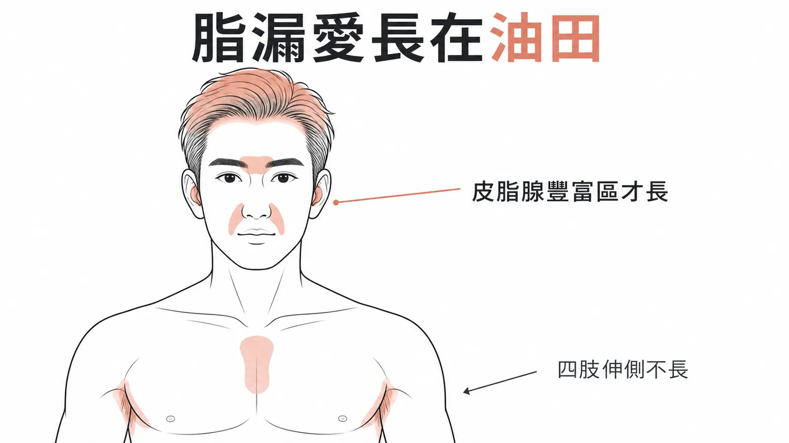 脂漏性皮膚炎好發部位：頭皮、眉毛、鼻翼兩側、耳後、胸骨前與皺褶等皮脂腺豐富區，四肢伸側不是好發區