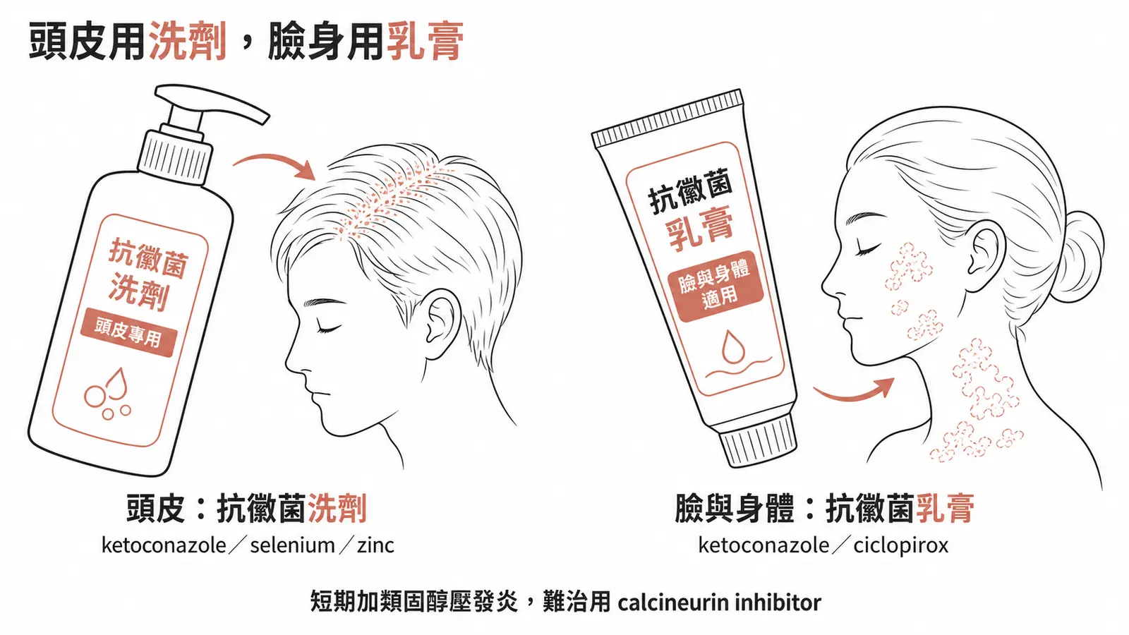 脂漏性皮膚炎治療：頭皮用抗黴菌洗劑，臉身用抗黴菌乳膏，頑固型短期搭配外用類固醇或 calcineurin inhibitor
