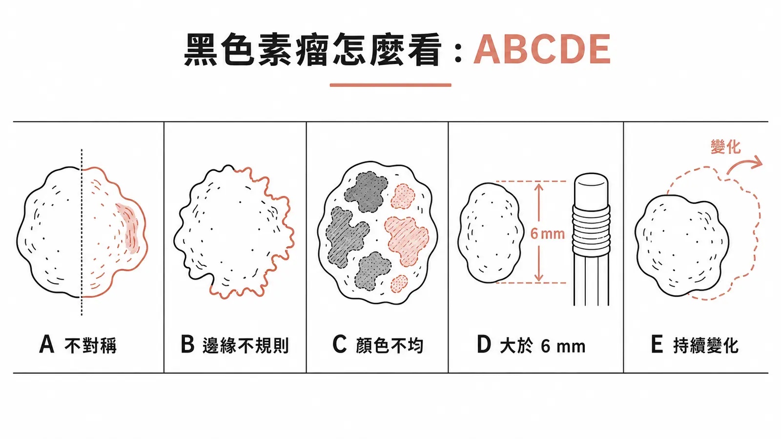 黑色素瘤 ABCDE 辨識:不對稱、邊緣不規則、顏色不均、直徑大於 6mm、變化