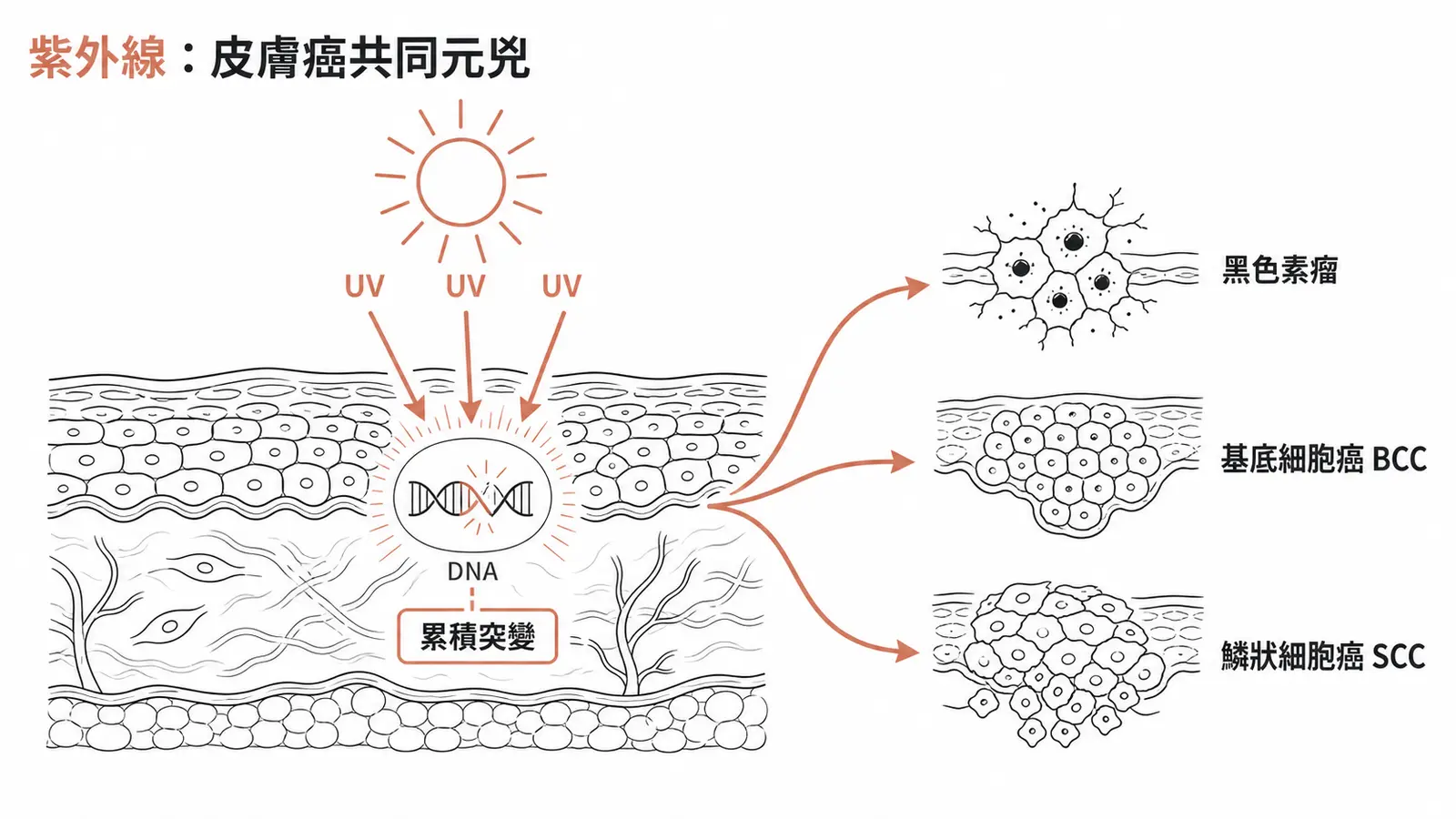 紫外線是三種皮膚癌共同主因:UV 傷害角質細胞 DNA,導致黑色素瘤、BCC、SCC