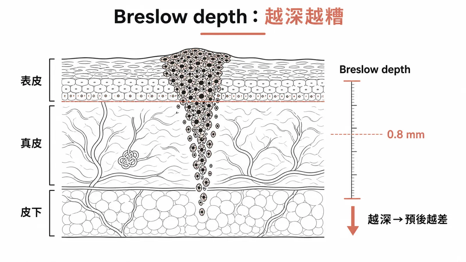 Breslow depth:黑色素瘤侵犯越深預後越差,大於 0.8mm 考慮前哨淋巴結切片