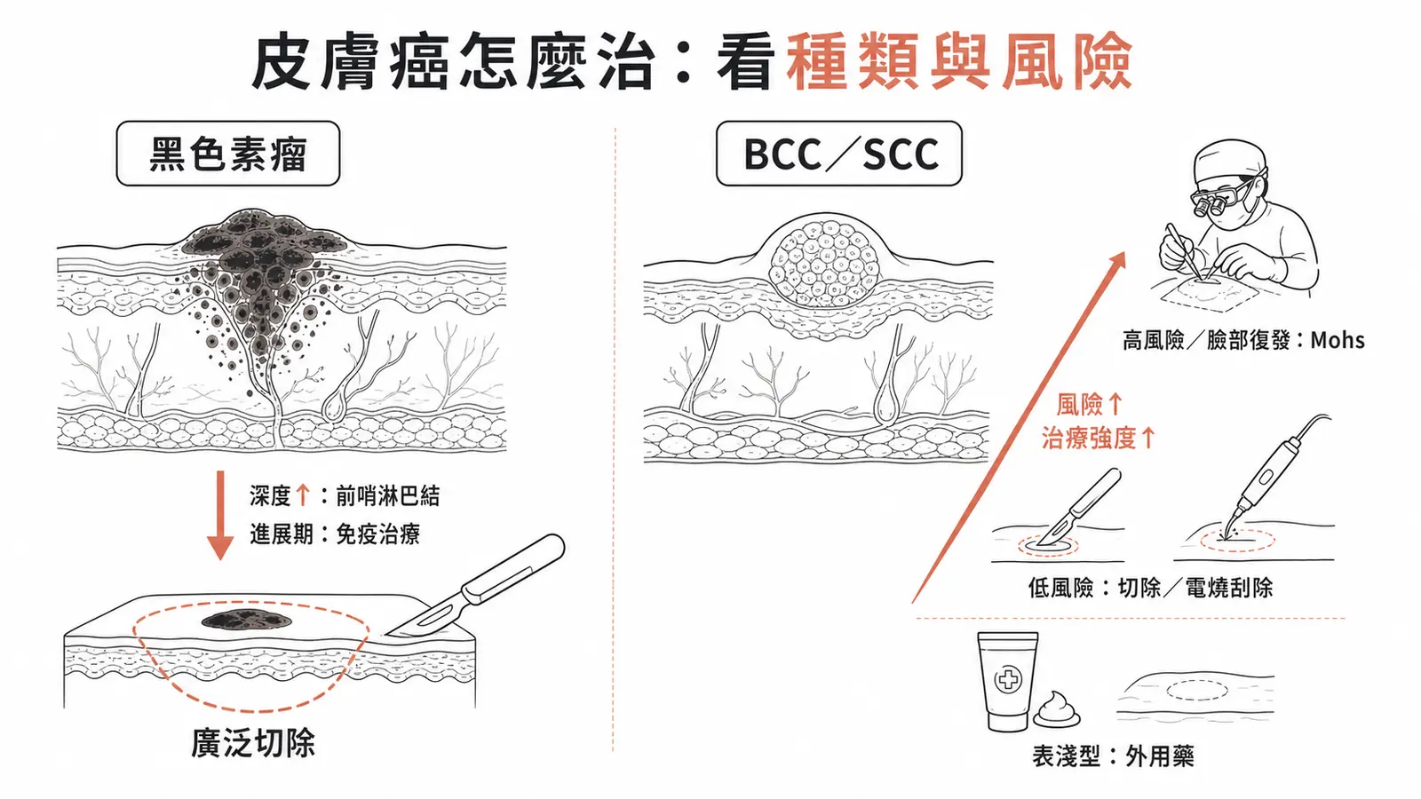 皮膚癌治療對照:黑色素瘤廣泛切除、高風險 BCC/SCC 用 Mohs、表淺型外用藥
