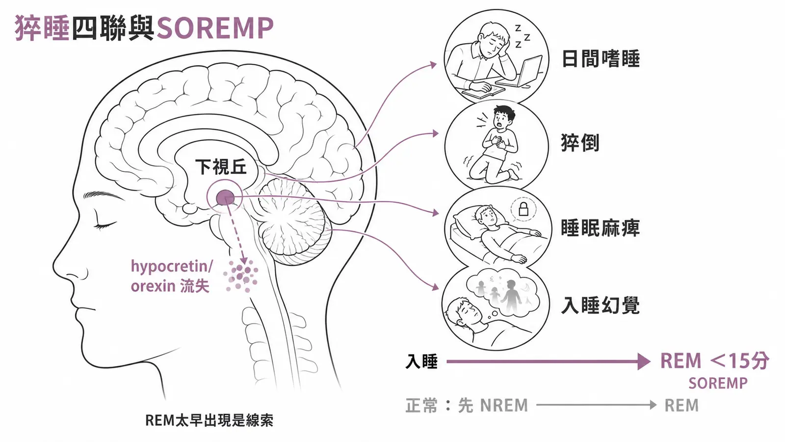 猝睡症四聯徵:日間嗜睡、猝倒、睡眠麻痺、入睡幻覺,源於 hypocretin 缺乏與入睡即 REM