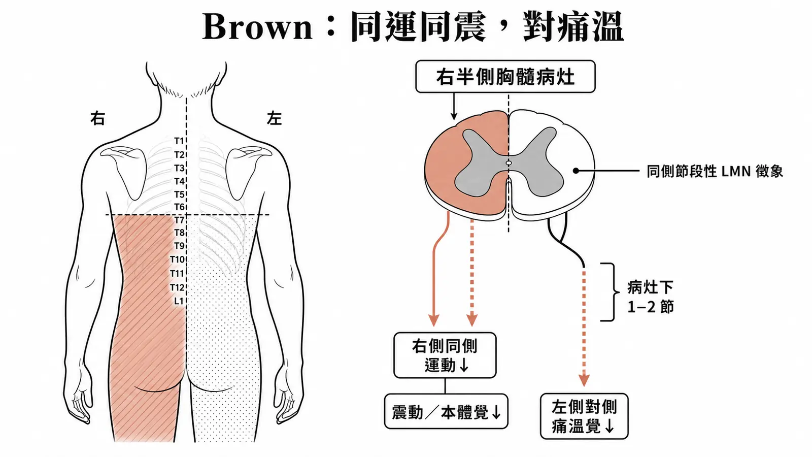 右側 Brown-Séquard syndrome：右側運動與震動本體覺下降，左側痛溫覺下降