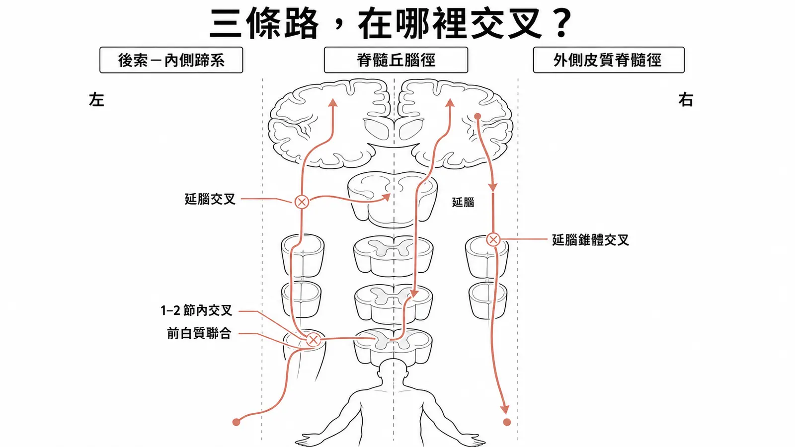 後索、脊髓丘腦徑與皮質脊髓徑的交叉位置：後索及皮質脊髓徑在延腦交叉，痛溫覺在脊髓交叉