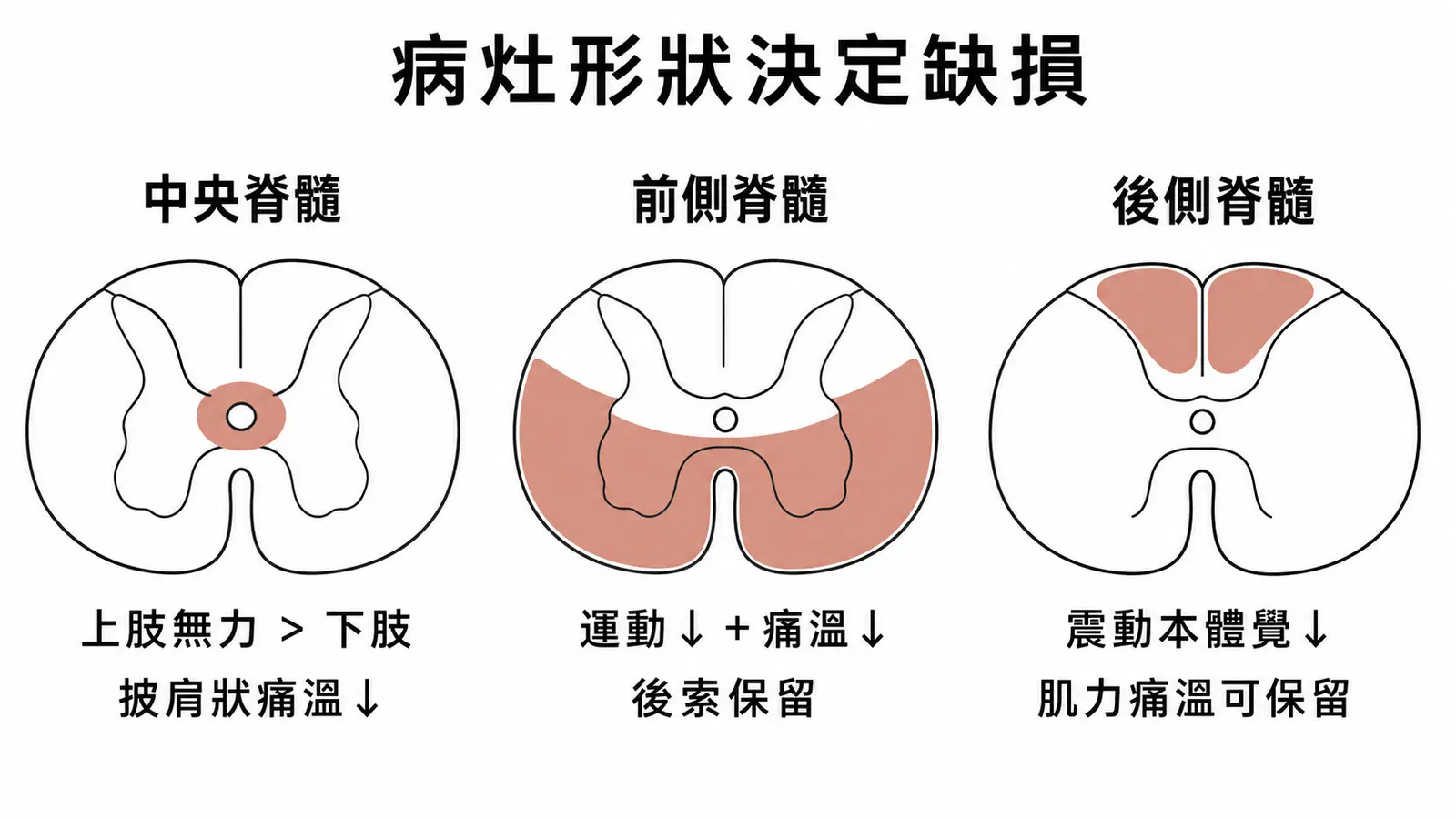 中央、前側與後側脊髓症候群對照：上肢較重、後索保留與後索選擇性缺損