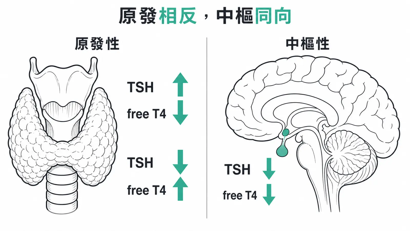原發性與中樞性甲狀腺疾病的 TSH 與 free T4 變化方向對照