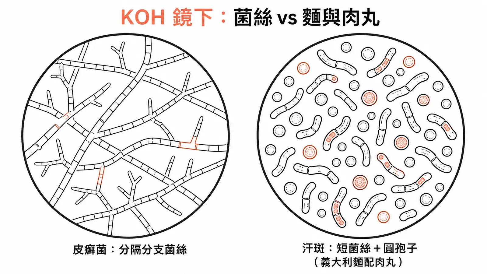 KOH 鏡下對照：皮癬菌為分隔分支菌絲，汗斑為短菌絲加圓孢子（義大利麵配肉丸）