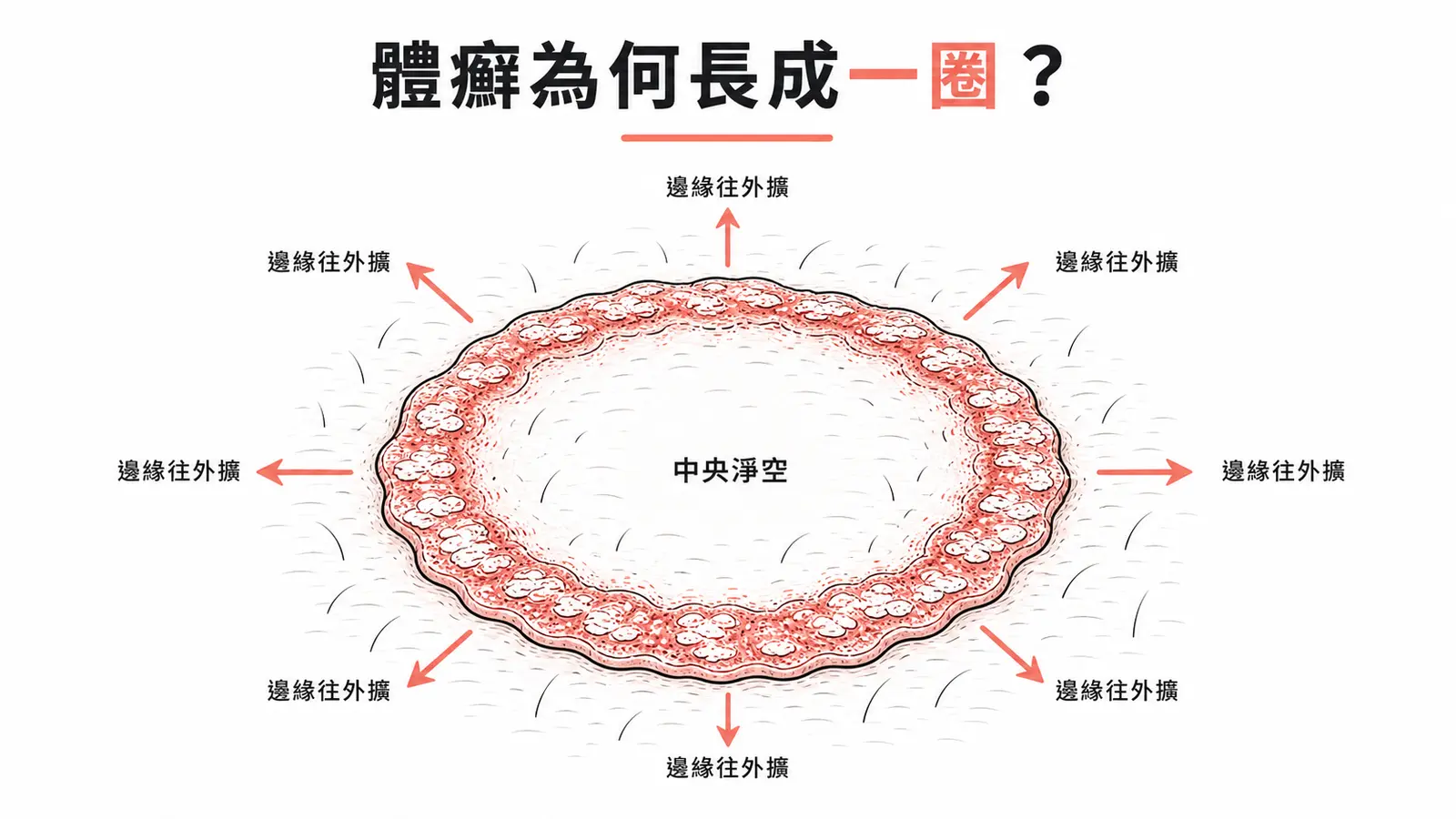 體癬環形病灶成因：菌絲在邊緣活躍往外擴散，中央因免疫反應趨緩而淨空