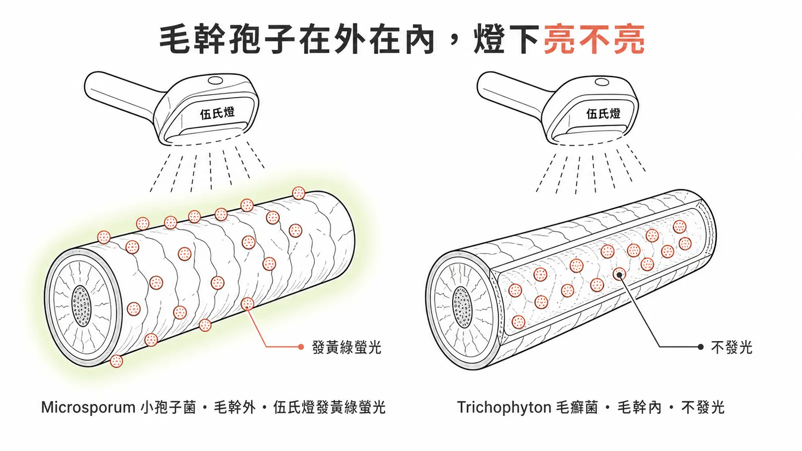 毛幹孢子位置與伍氏燈：Microsporum 毛幹外發黃綠螢光，Trichophyton 毛幹內不發光