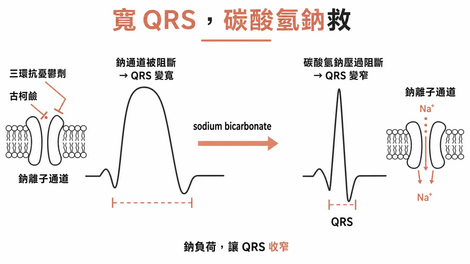 三環抗憂鬱劑與古柯鹼中毒:阻斷心肌鈉離子通道造成 QRS 變寬與心律不整,sodium bicarbonate 靠鹼化與鈉負荷壓過鈉通道阻斷、讓 QRS 變窄