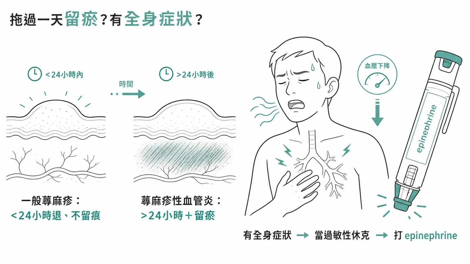 蕁麻疹的兩個必考鑑別:單一膨疹 24 小時內消退是一般蕁麻疹,超過 24 小時不退且留瘀是蕁麻疹性血管炎;合併喘鳴低血壓等全身症狀要當過敏性休克、給 epinephrine