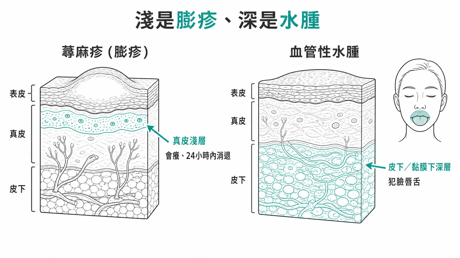 蕁麻疹與血管性水腫的深度對照:蕁麻疹是真皮淺層、會癢、24 小時內消退的膨疹;血管性水腫是皮下或黏膜下的深層腫脹,常犯臉、嘴唇、舌頭