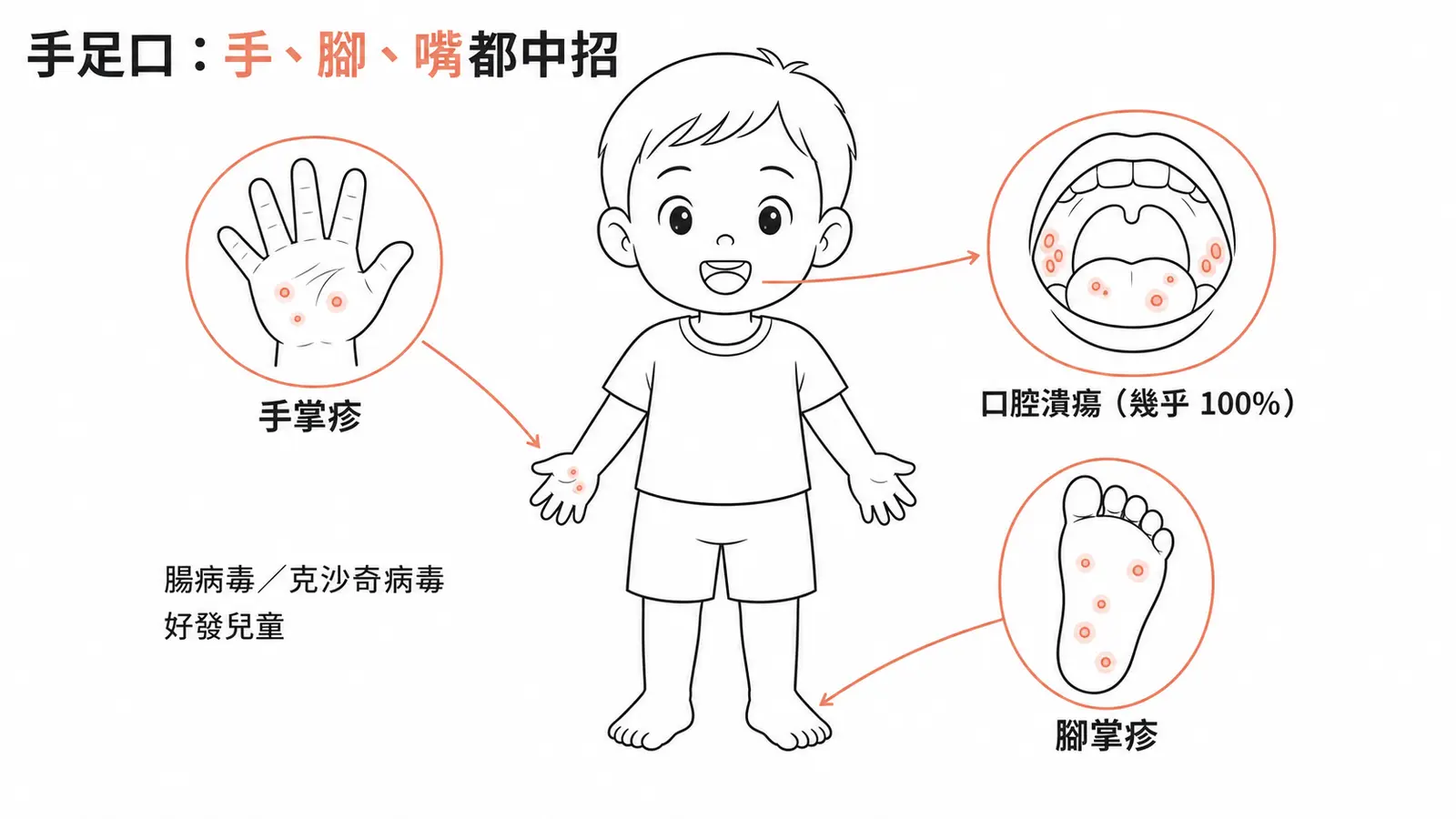 手足口病的分布:好發兒童,手掌與腳掌的斑丘疹或丘疹水疱,加上疼痛的口腔潰瘍(幾乎百分之百出現),由腸病毒與克沙奇病毒引起