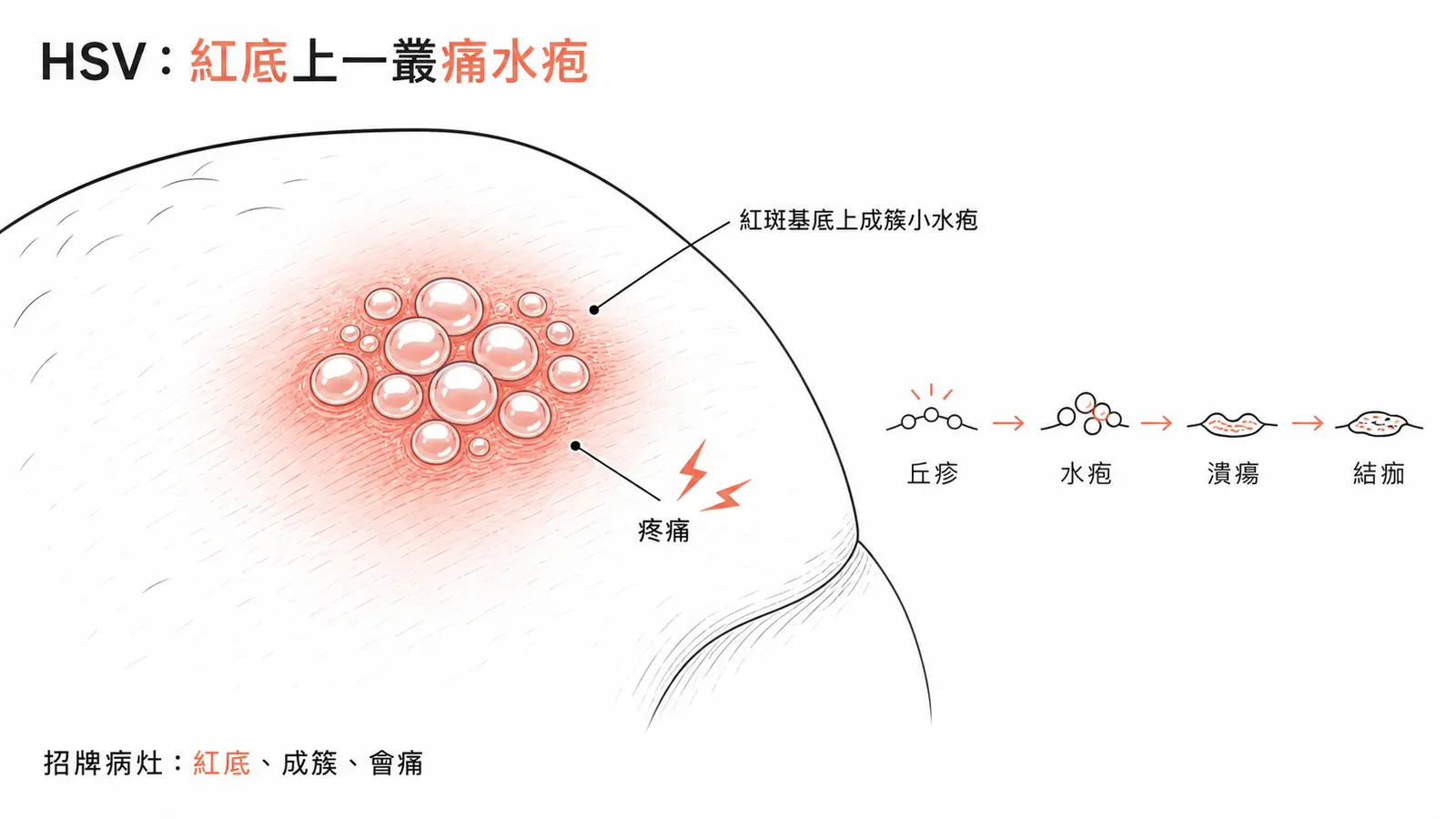 單純疱疹的招牌病灶:紅斑基底上一叢緊密成簇的小水疱、疼痛,會經丘疹、水疱、潰瘍演變
