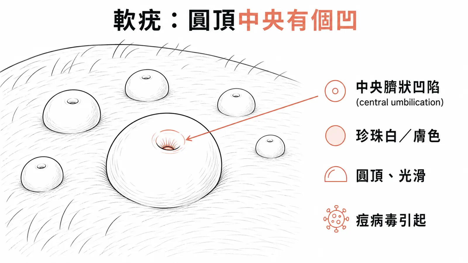 傳染性軟疣的招牌病灶:小而光滑、圓頂狀、珍珠白或膚色的丘疹,中央有臍狀凹陷;由痘病毒引起